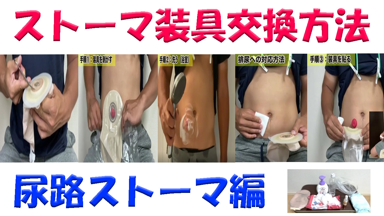 オストメイト】ストーマ装具交換方法（尿路ストーマ） – NPO m-akt
